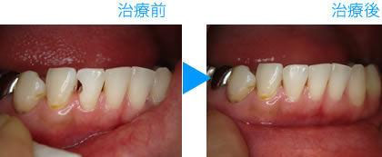 グラディアダイレクト治療例