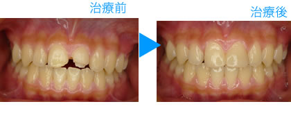 グラディアダイレクト治療例