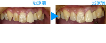 グラディアダイレクト治療例