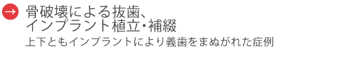 骨破壊による抜歯、インプラント植立・補綴